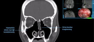 Navigasyonel Sinüs Cerrahisi - Op. Dr. Erkan Aktan